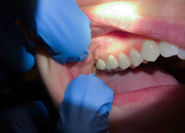 Best Emergency Treatment for Dental Infections or Abscesses in Unalaska, AK